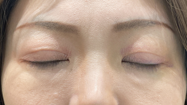 手術前の状態 その1