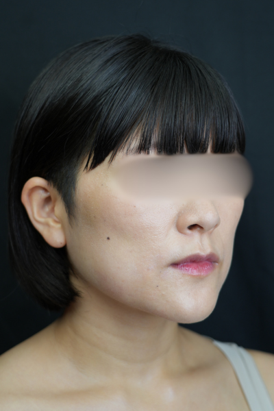 手術前の状態 その1