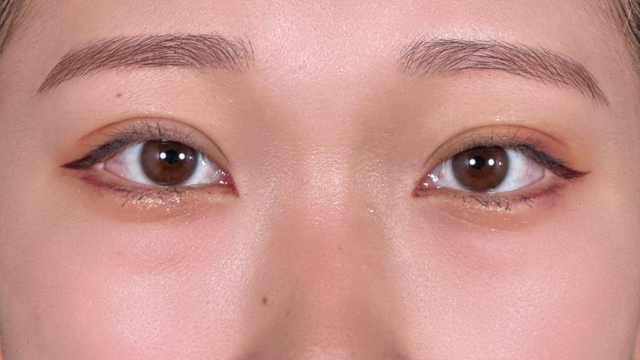 手術前の状態 その1