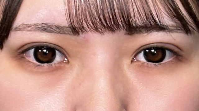 手術前の状態 その1