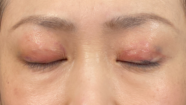 手術前の状態 その1