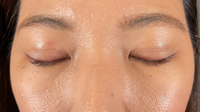 手術前の状態 その1