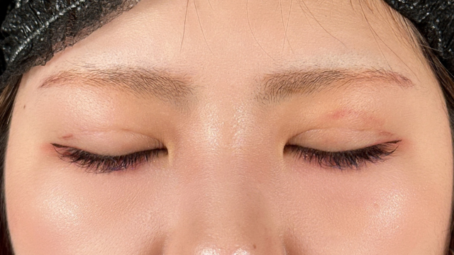 手术前的状态 其一