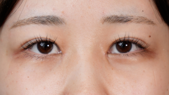 手術前の状態 その1