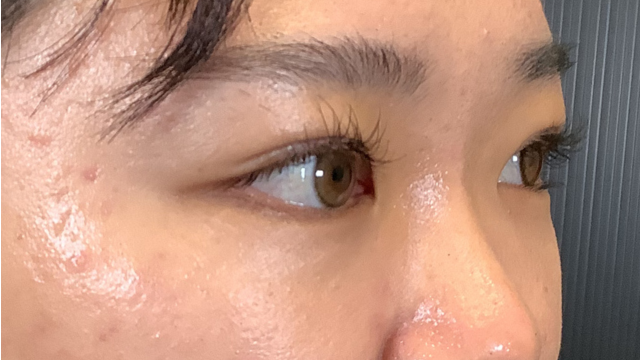 手術前の状態 その1