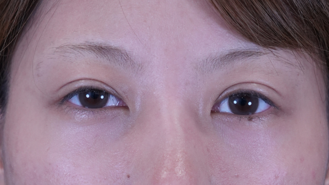 手術前の状態 その1