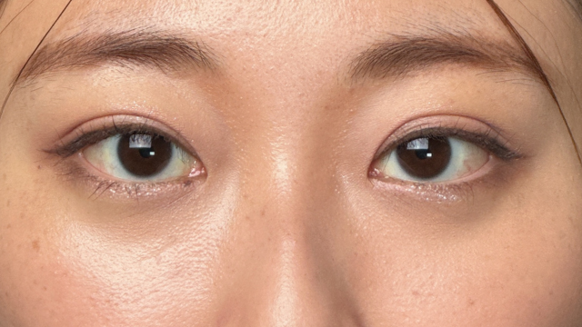 手術前の状態 その1