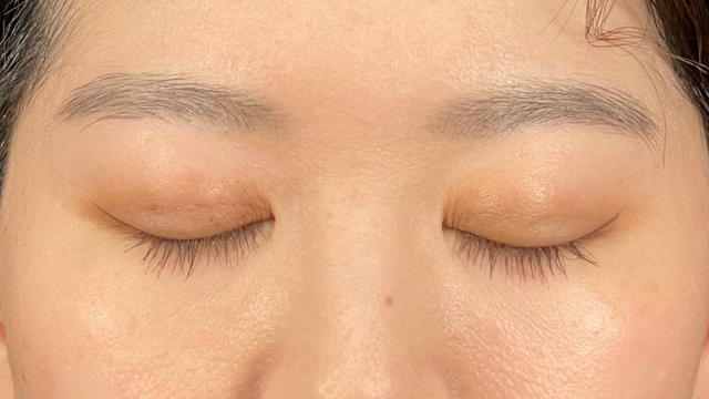 手術前の状態 その1