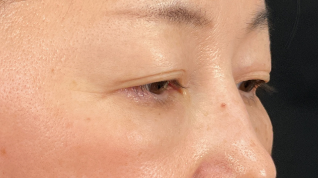 手术前的状态 其一