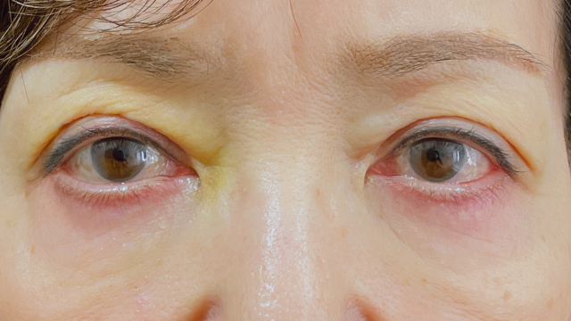 Postoperative Condition Part 1