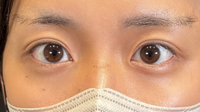 手术前的状态 其一