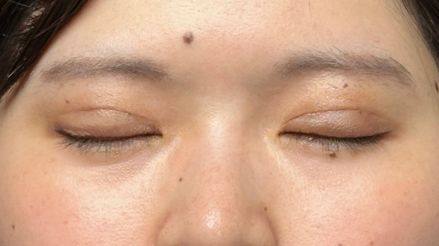 手术前的状态 其一