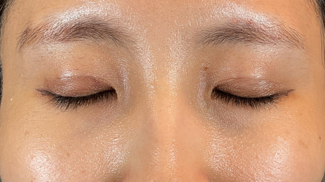 手術前の状態 その1