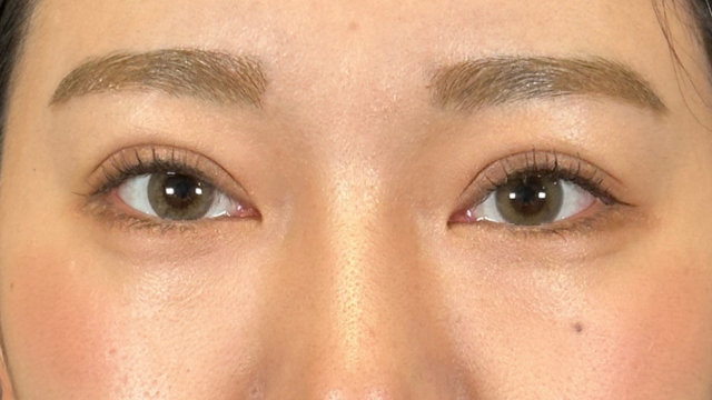 手術前の状態 その1