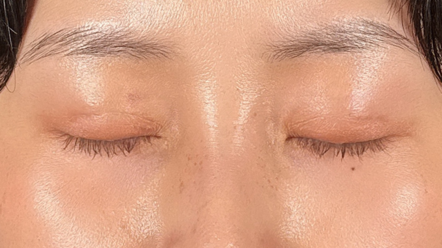 手术前的状态 其一