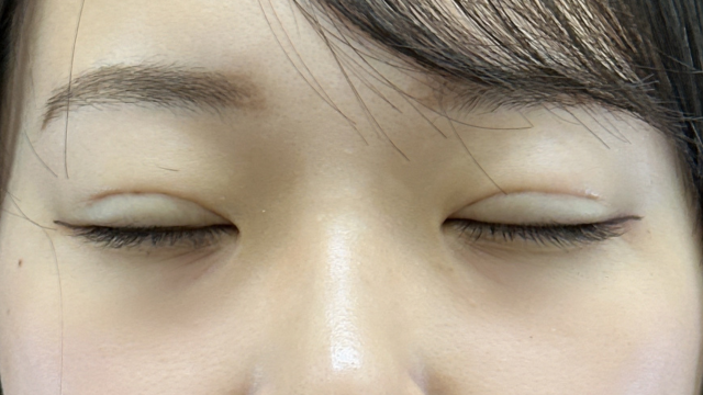 手术前的状态 其一