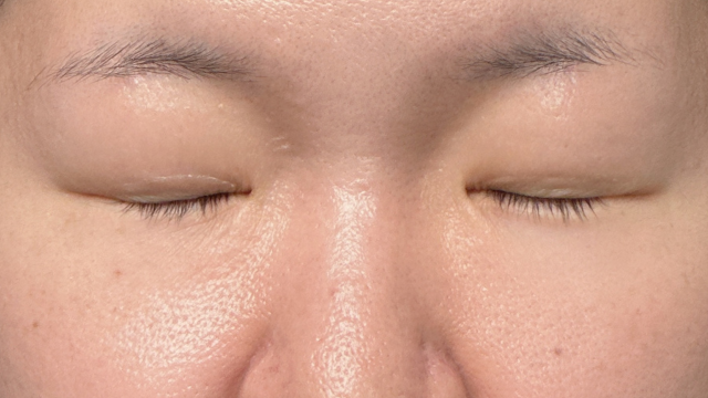 手术前的状态 其一