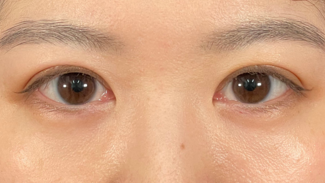 手術前の状態 その1