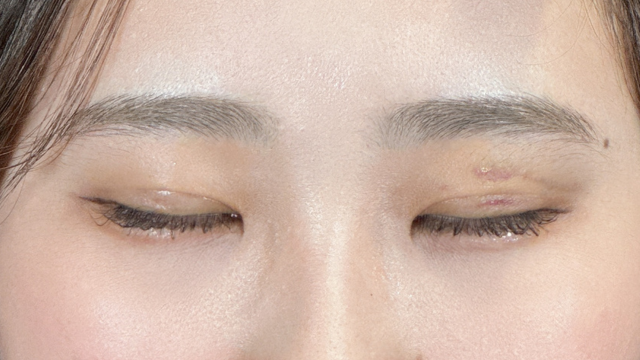 手术前的状态 其一