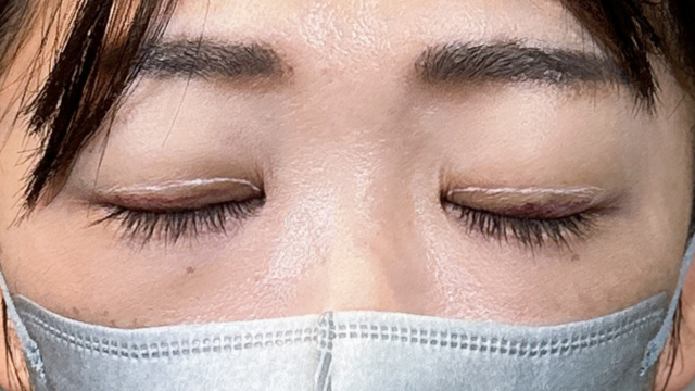 手術前の状態 その1