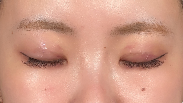 Postoperative Condition Part 1