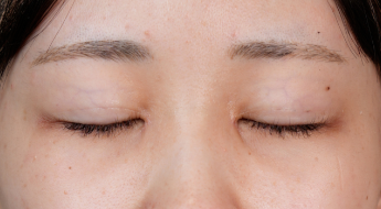 手術前の状態 その1