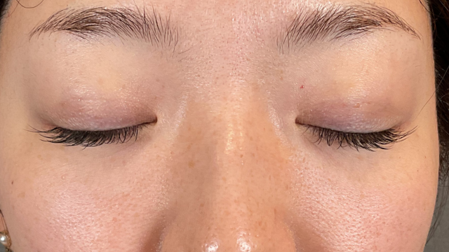 手术前的状态 其一