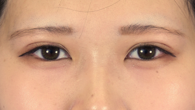 手術前の状態 その1