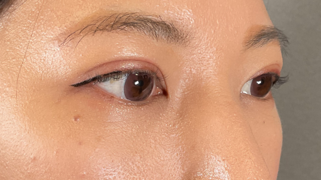 手術前の状態 その1