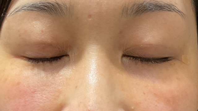 手术前的状态 其一