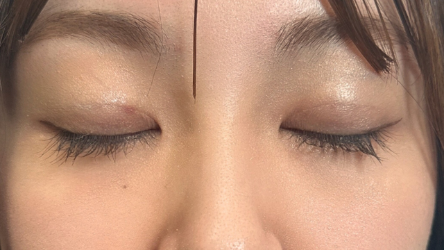 手术前的状态 其一