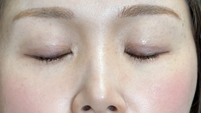 手術前の状態 その1