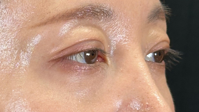 手術前の状態 その1