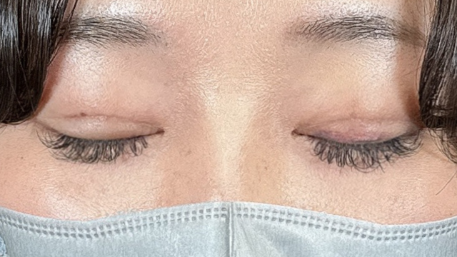 手术前的状态 其一