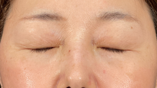 手术前的状态 其一