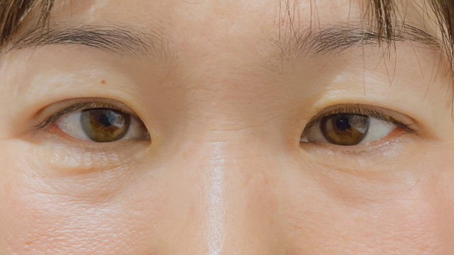 手术前的状态 其一