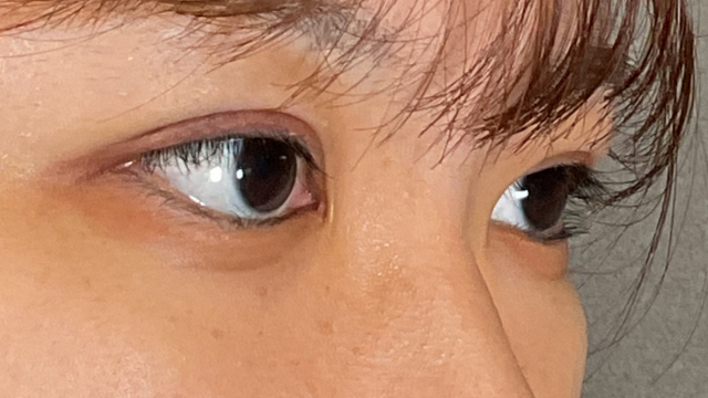 手术前的状态 其一