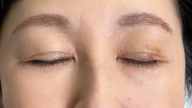 手术前的状态 其一