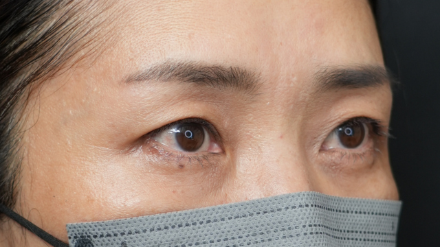 手術前の状態 その1