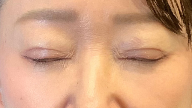 手術前の状態 その1