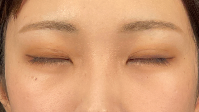 手術前の状態 その1