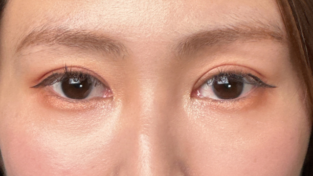 手術前の状態 その1