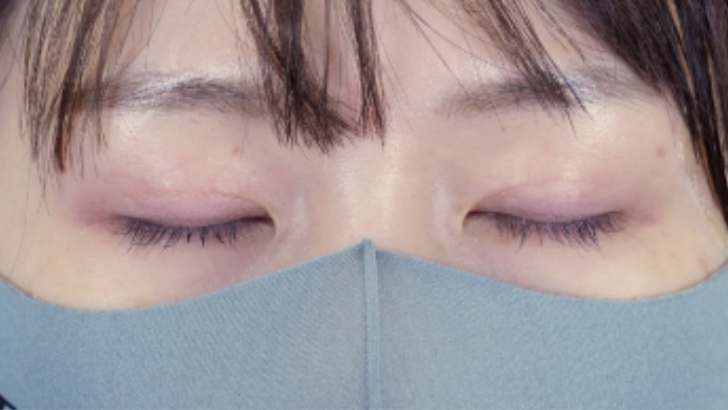 手术前的状态 其一