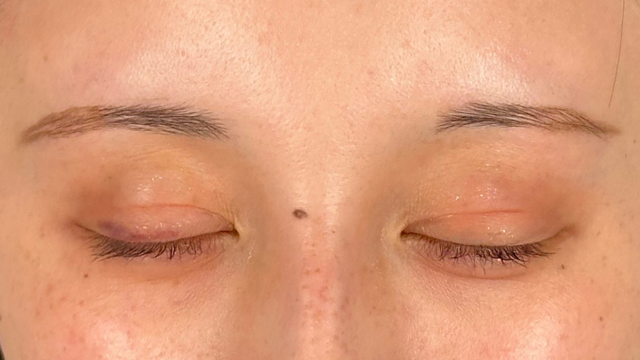 手术前的状态 其一