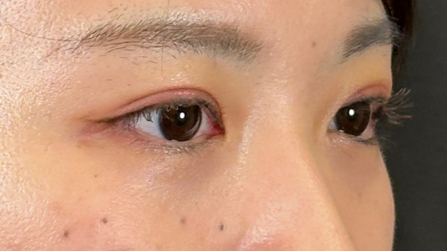 Postoperative Condition Part 1