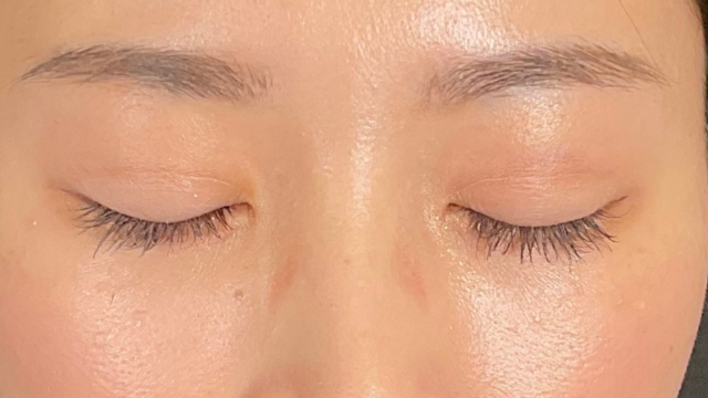 手术前的状态 其一