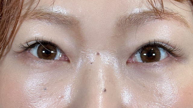 手术前的状态 其一