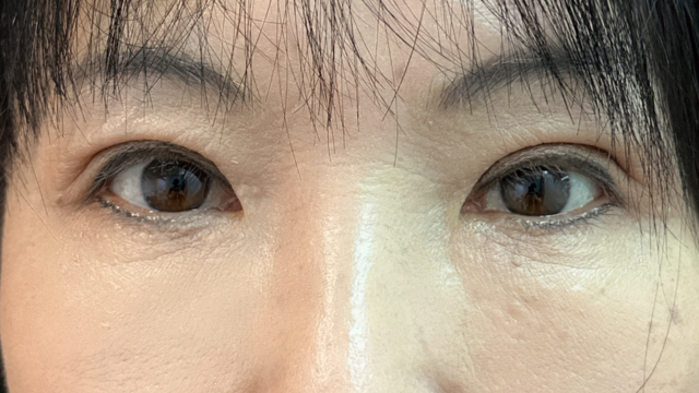 手術前の状態 その1