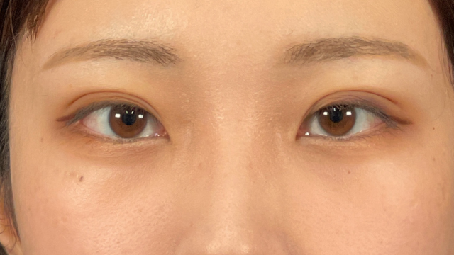 手術前の状態 その1