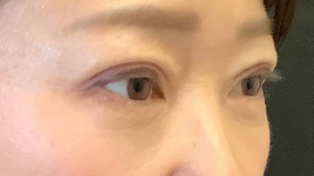 手術前の状態 その1